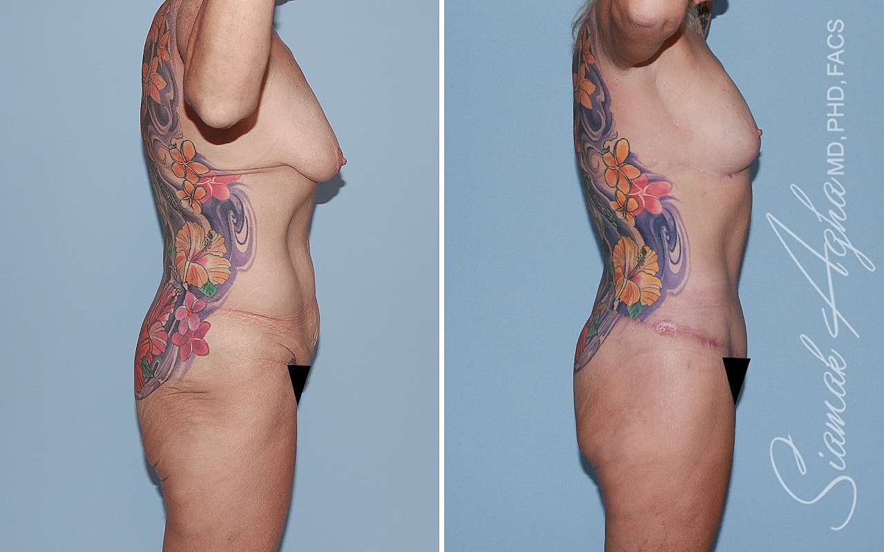 Total Body Lift Before & After