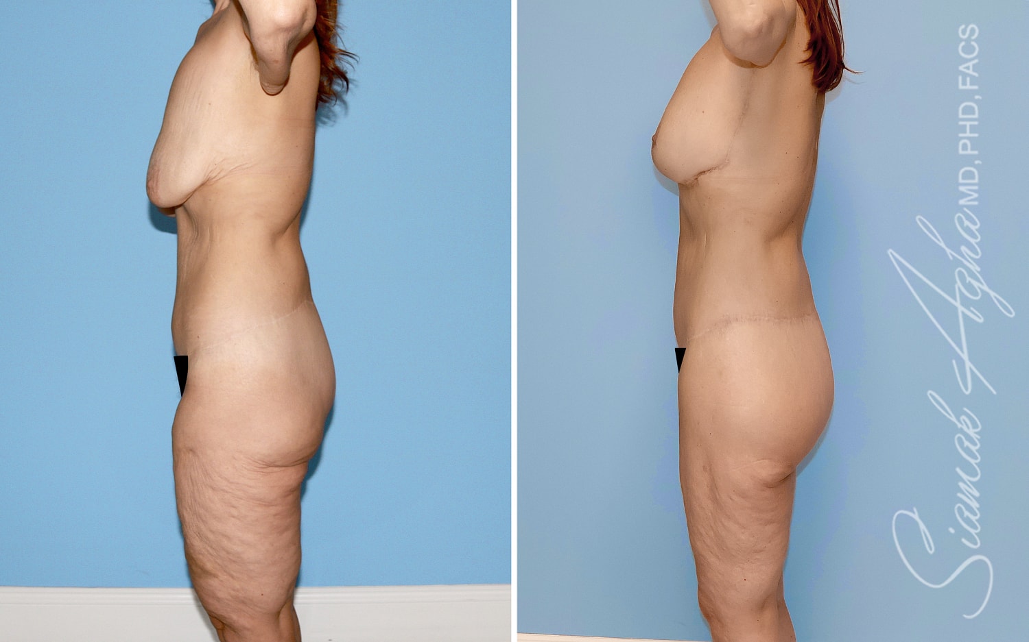 Total Body Lift Before & After