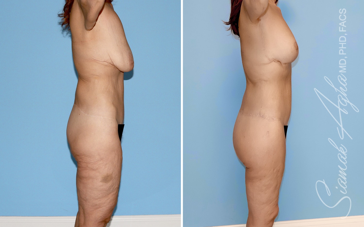 Total Body Lift Before & After