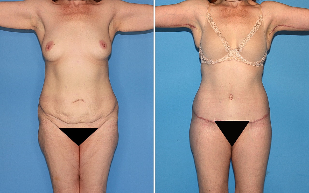 Total Body Lift Before & After
