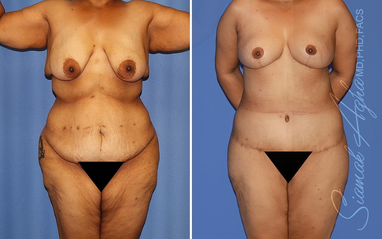 Total Body Lift Before & After