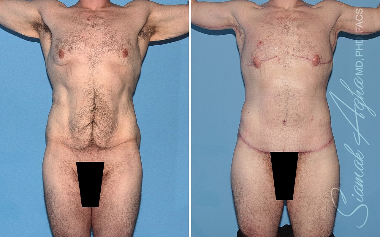 Total Body Lift Before & After