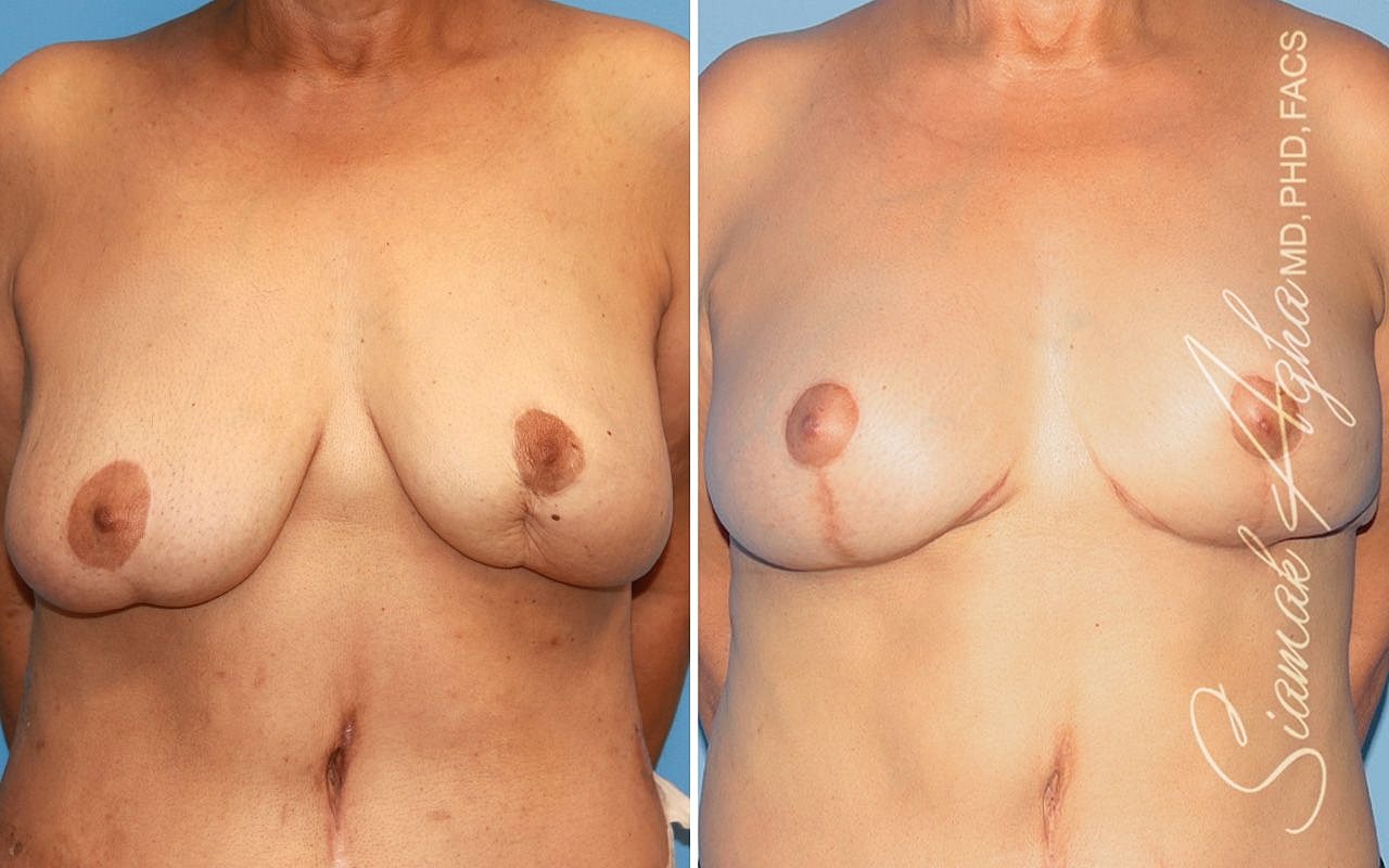 Breast Reconstruction Before & After