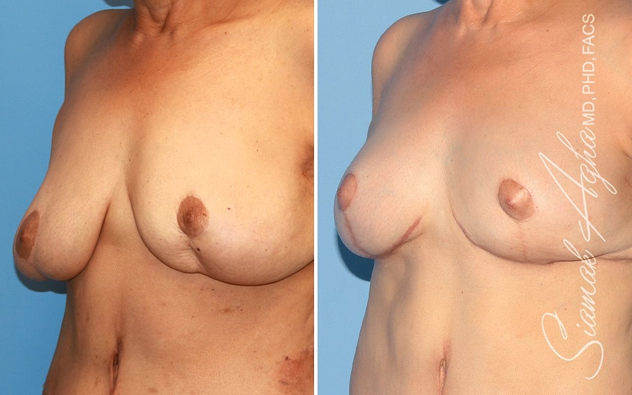 Breast Reconstruction Before & After