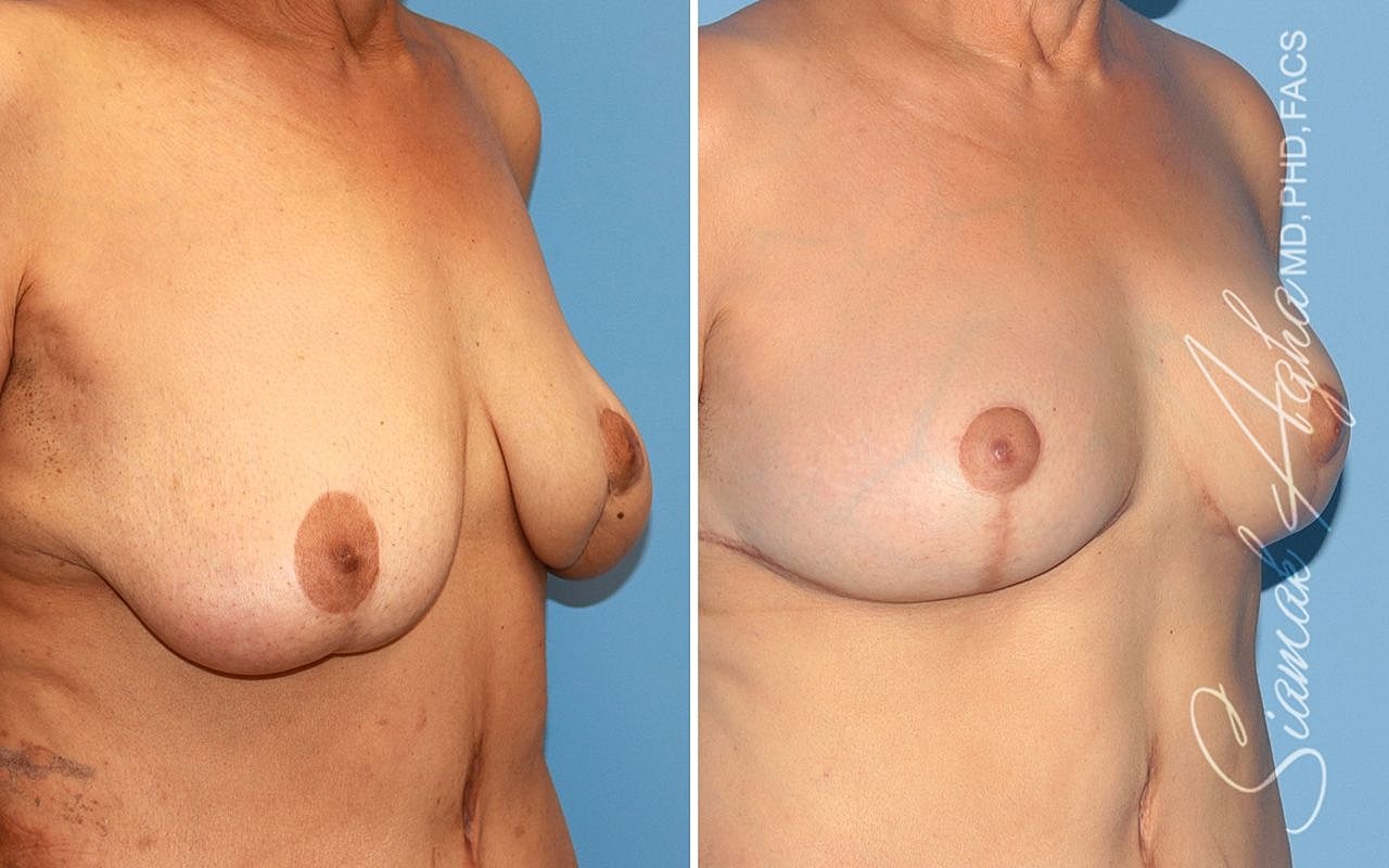 Breast Reconstruction Before & After