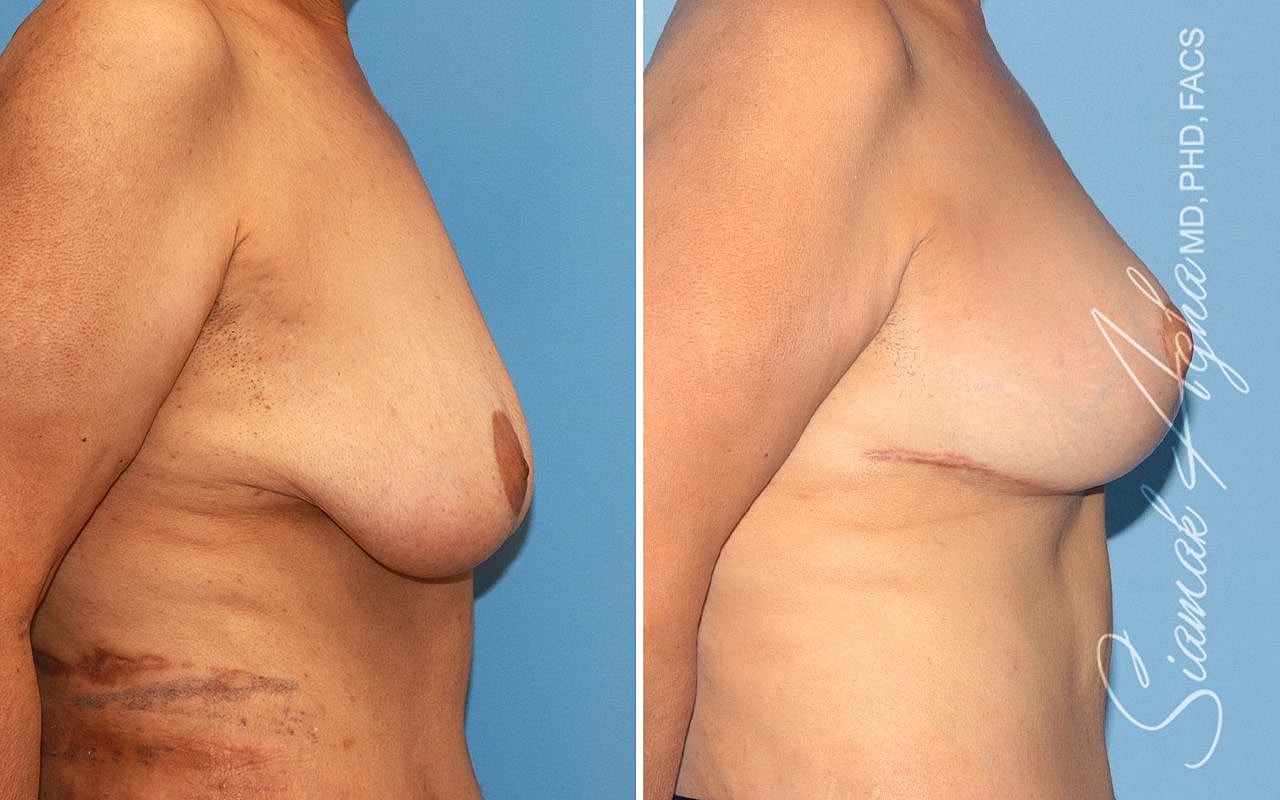 Breast Reconstruction Before & After