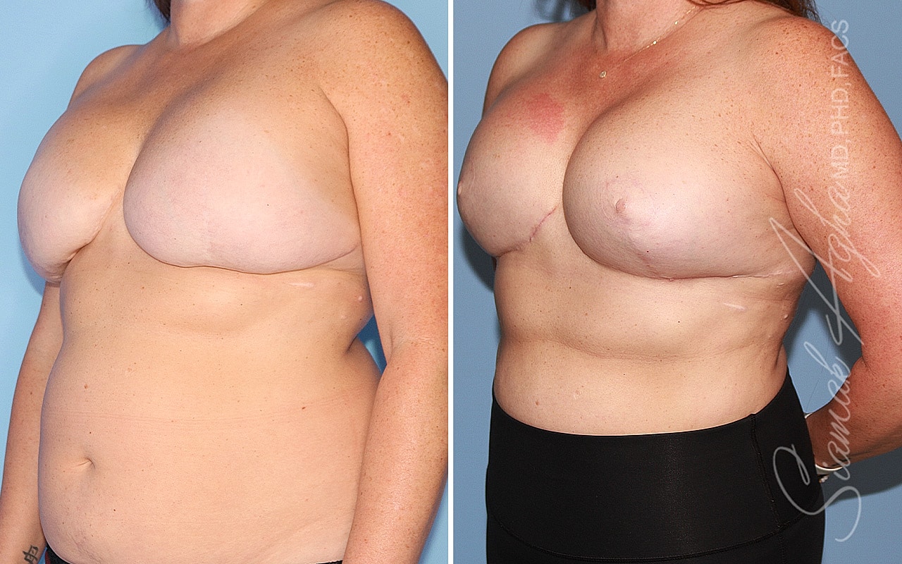 Breast Reconstruction Before & After