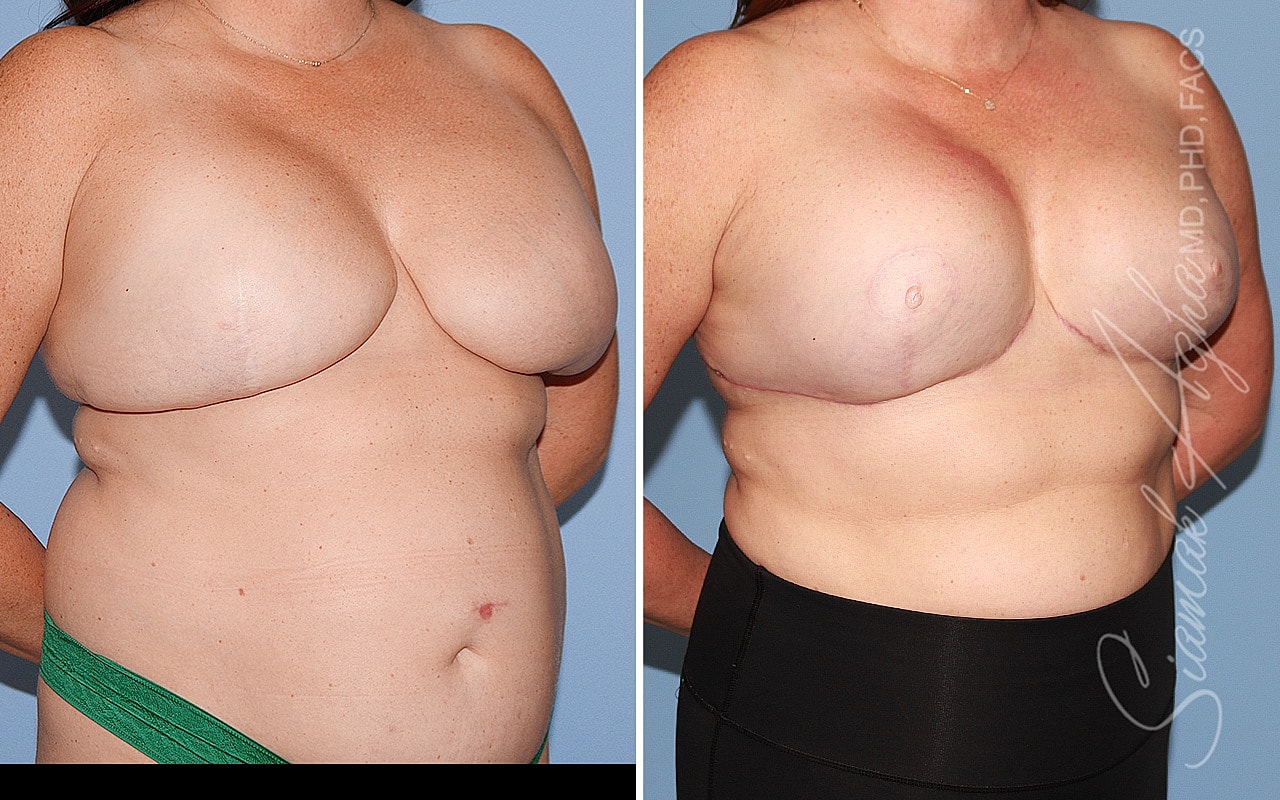 Breast Reconstruction Before & After