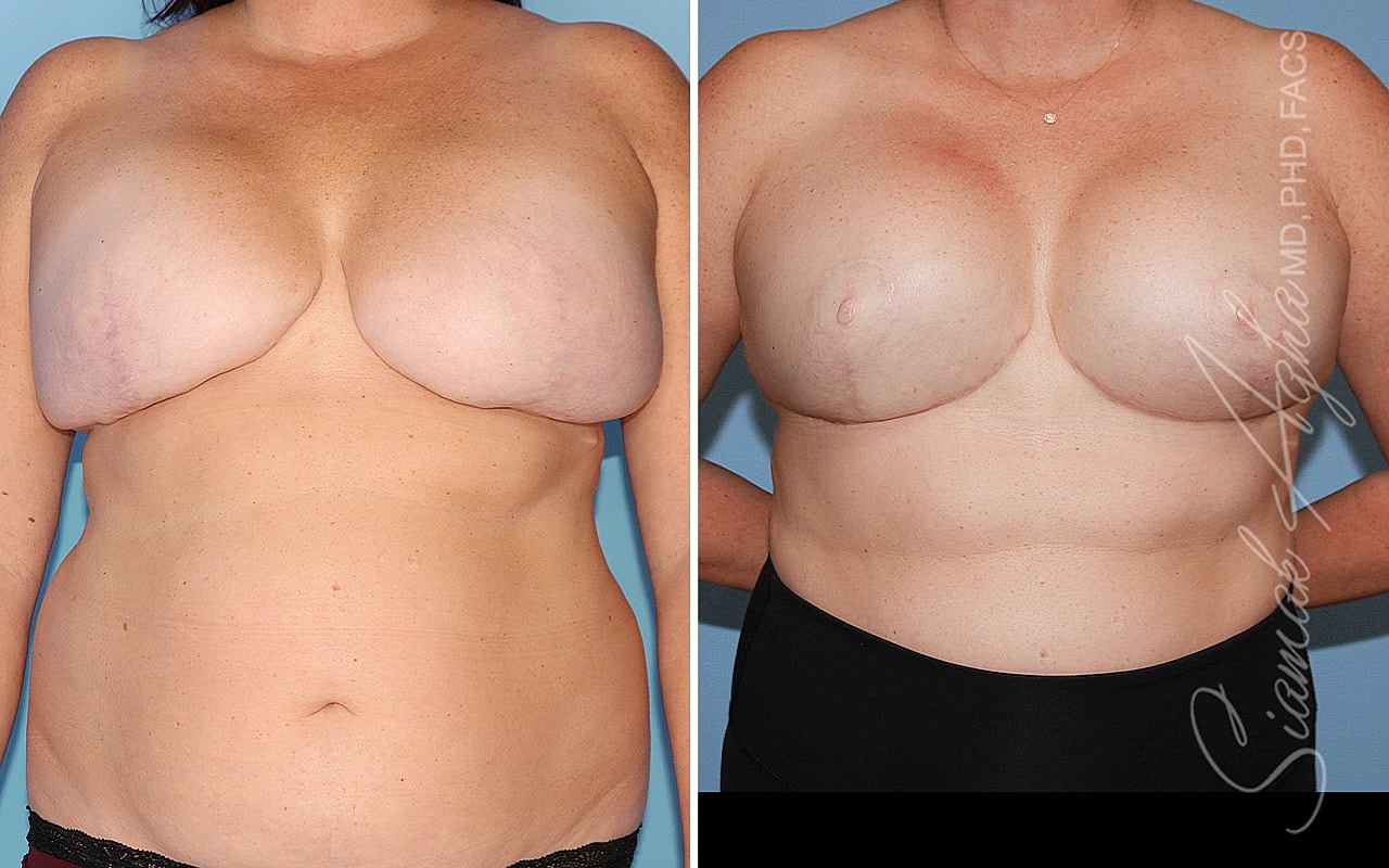 Breast Reconstruction Before & After