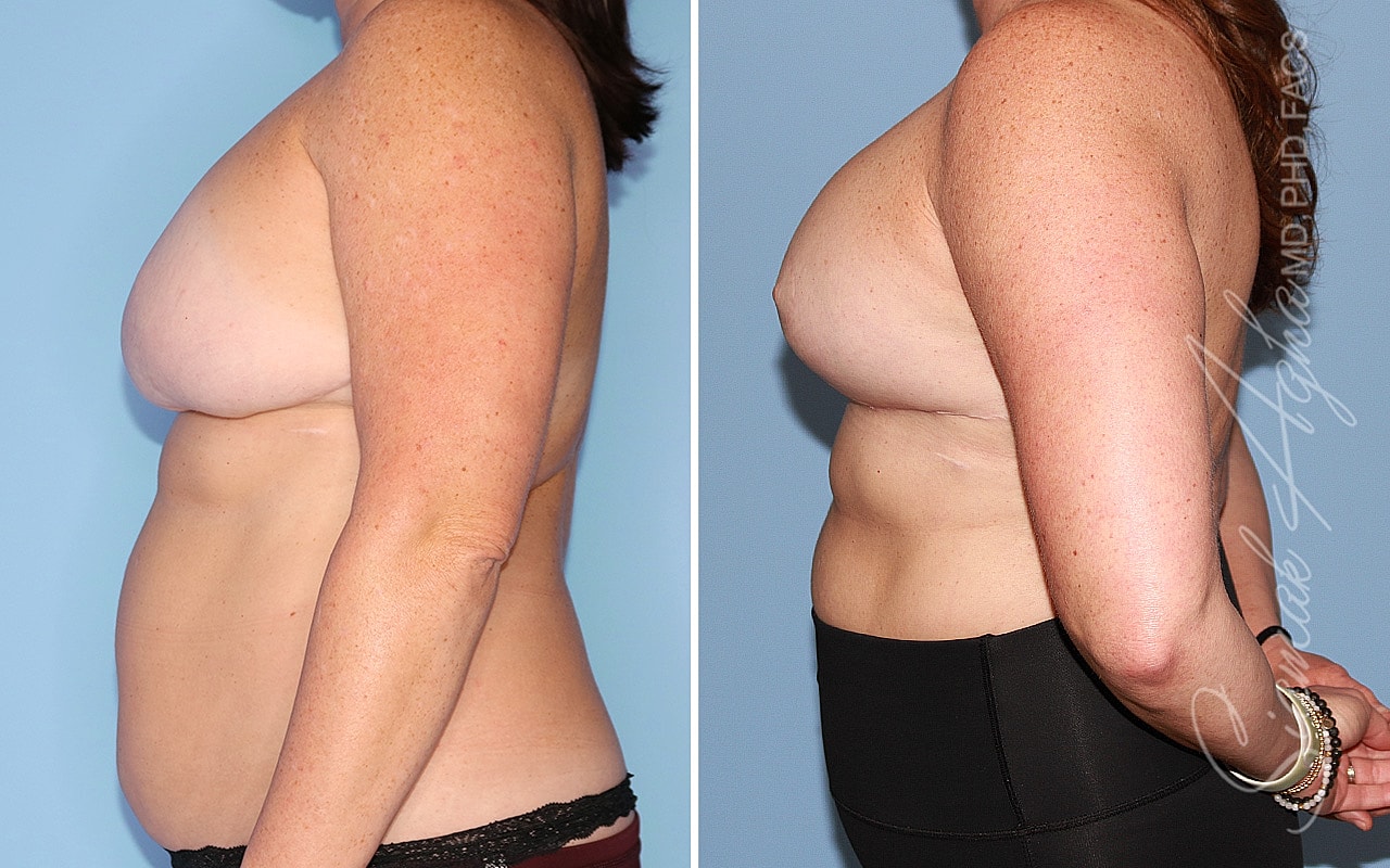 Breast Reconstruction Before & After