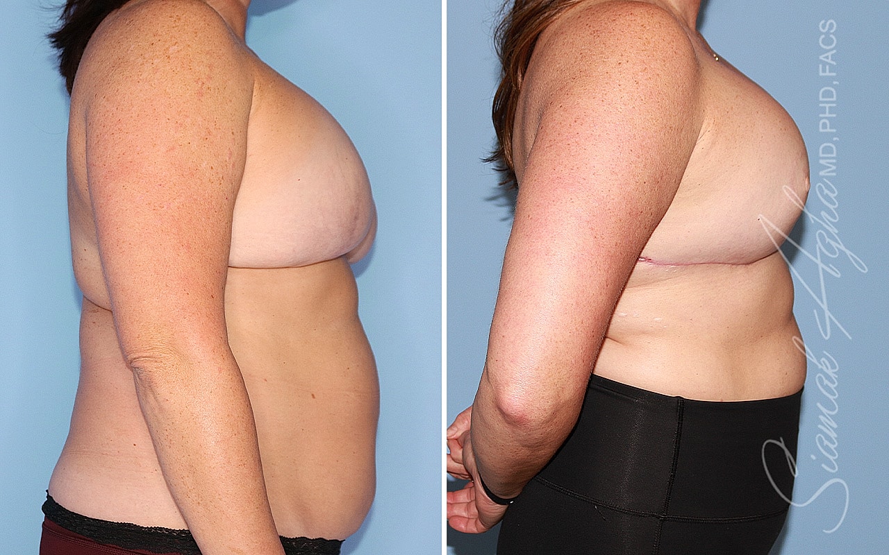 Breast Reconstruction Before & After