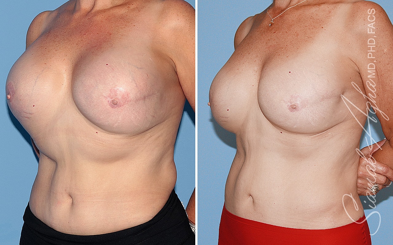Breast Reconstruction Before & After