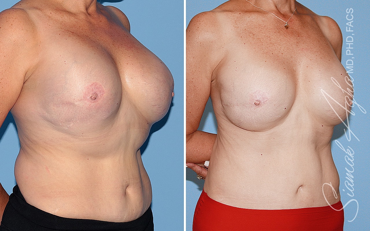 Breast Reconstruction Before & After