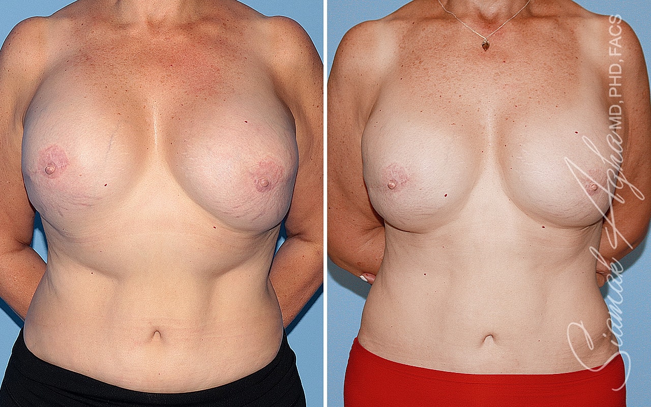 Breast Reconstruction Before & After