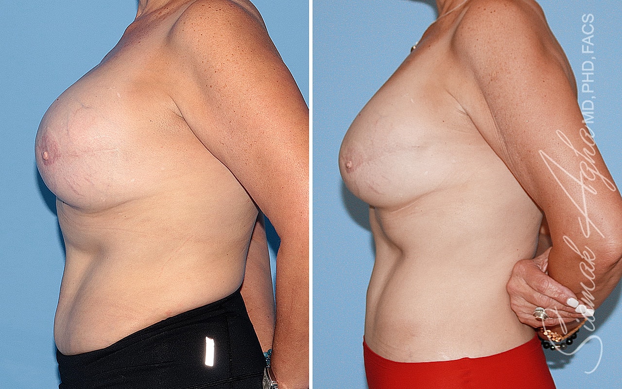 Breast Reconstruction Before & After