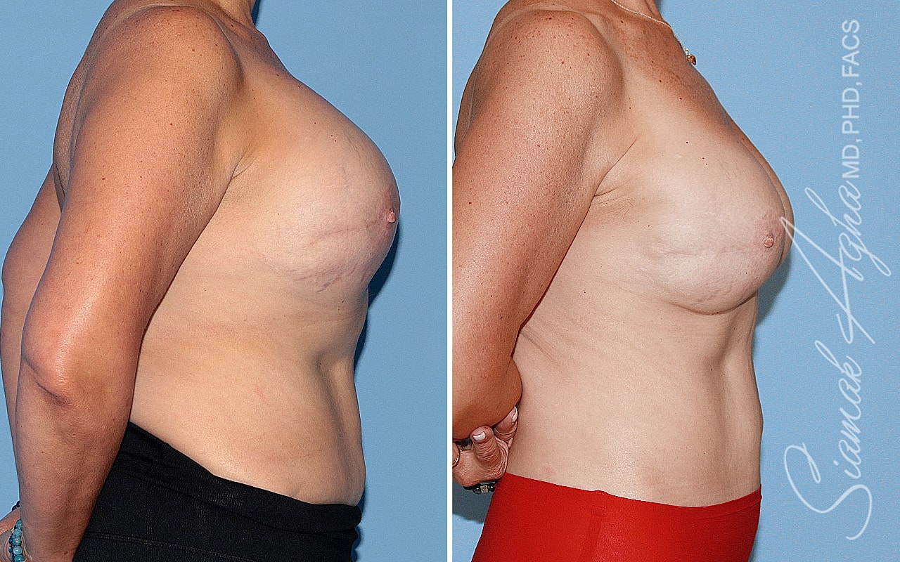 Breast Reconstruction Before & After