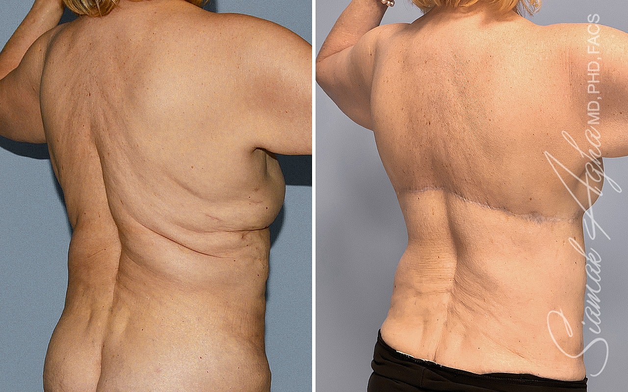 Breast Reconstruction Before & After