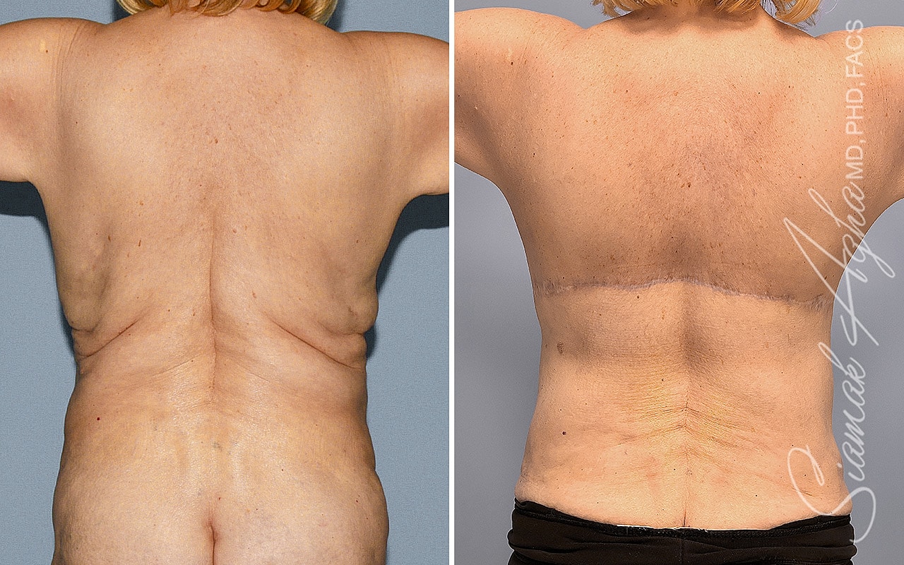 Breast Reconstruction Before & After