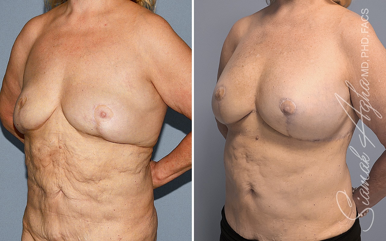 Breast Reconstruction Before & After