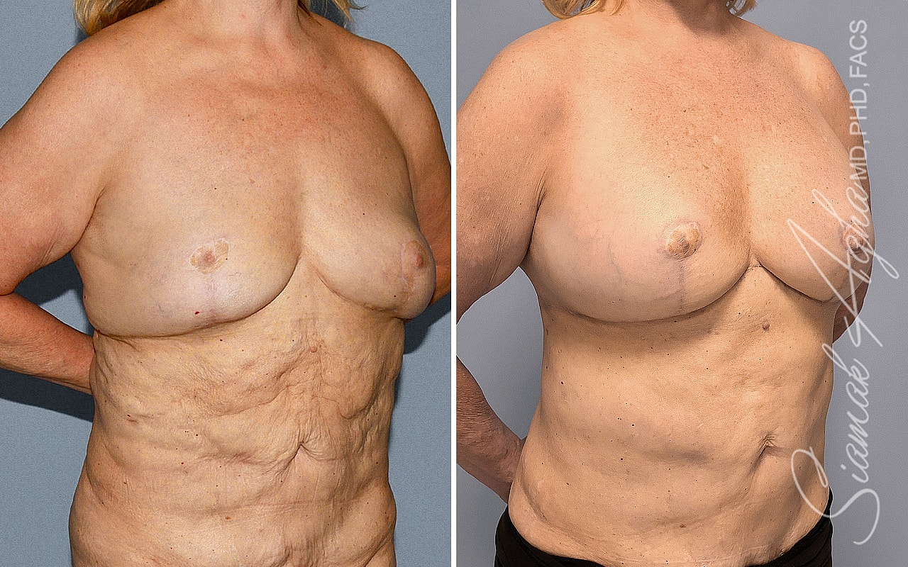Breast Reconstruction Before & After