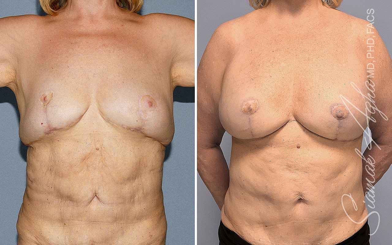 Breast Reconstruction Before & After