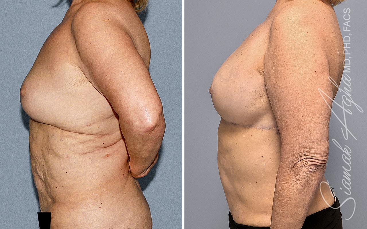 Breast Reconstruction Before & After