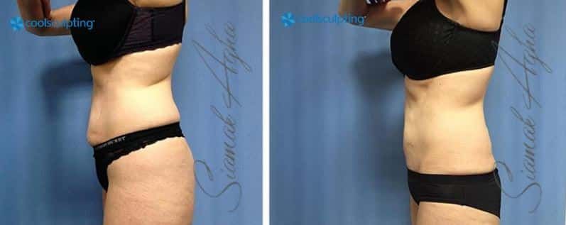 CoolSculpting Before & After