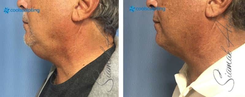CoolSculpting Before & After