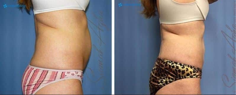 CoolSculpting Before & After