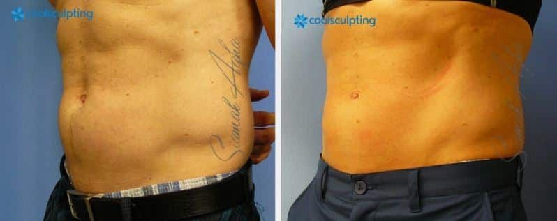CoolSculpting Before & After