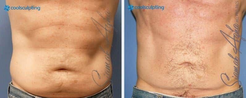 CoolSculpting Before & After
