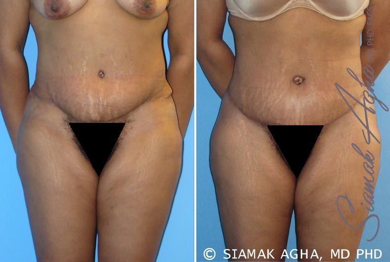 Tummy Tuck Revision Before & After