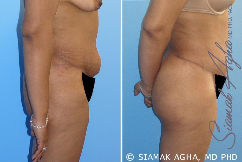Tummy Tuck Revision Before & After