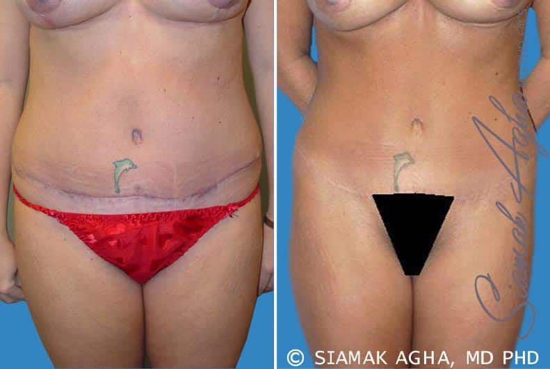 Tummy Tuck Revision Before & After