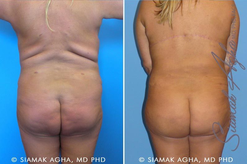 Tummy Tuck Revision Before & After