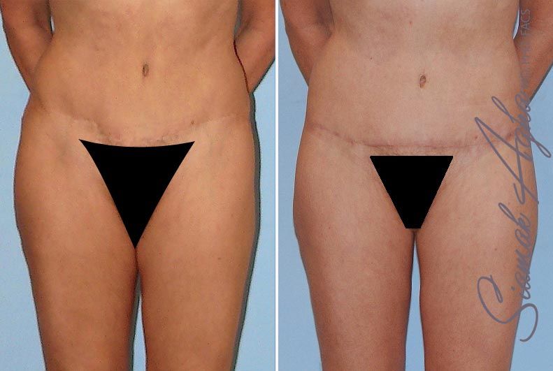 Tummy Tuck Revision Before & After