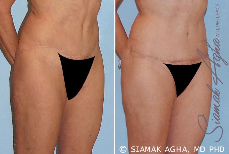 Tummy Tuck Revision Before & After