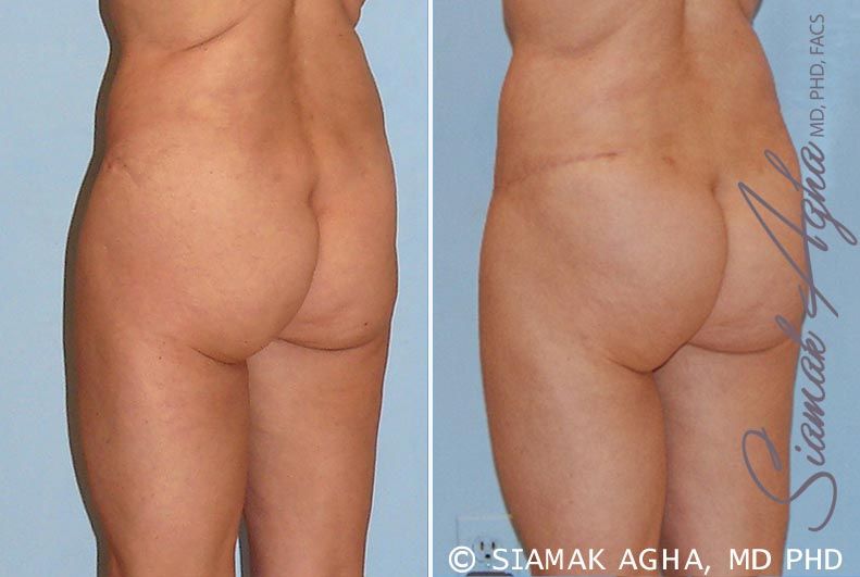 Tummy Tuck Revision Before & After