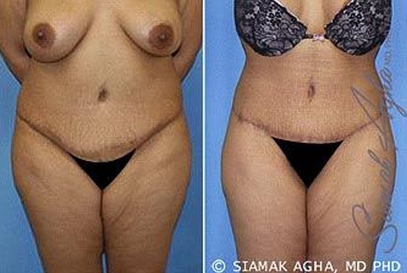 Before and after body contouring image.