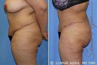 Tummy Tuck Revision Before & After