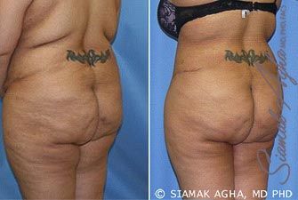 Tummy Tuck Revision Before & After