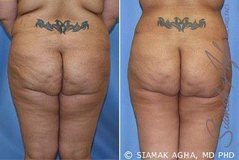 Tummy Tuck Revision Before & After