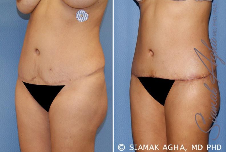 Tummy Tuck Revision Before & After