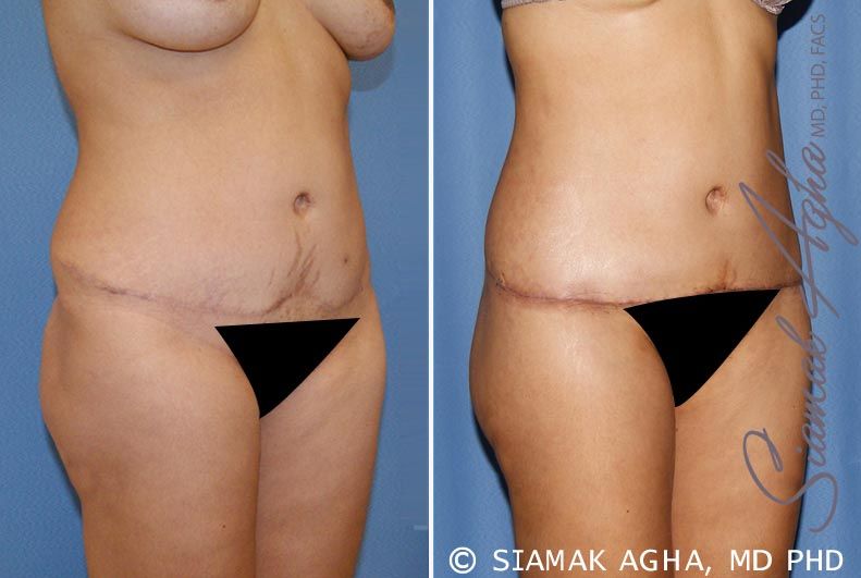 Tummy Tuck Revision Before & After