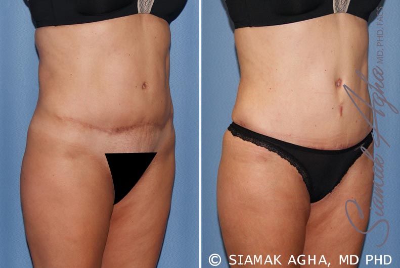 Tummy Tuck Revision Before & After