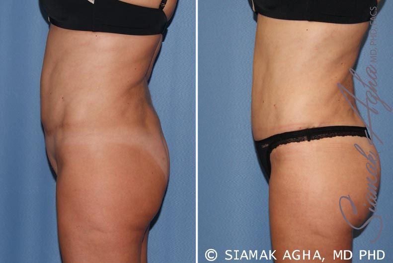 Tummy Tuck Revision Before & After