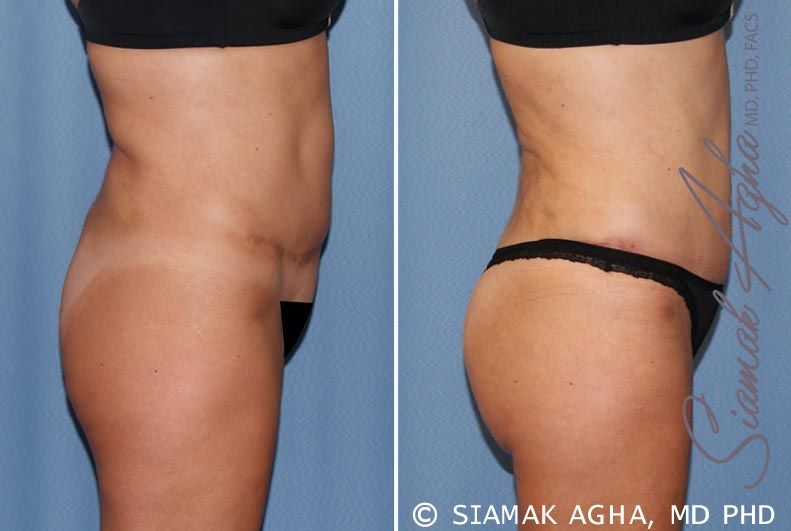 Tummy Tuck Revision Before & After