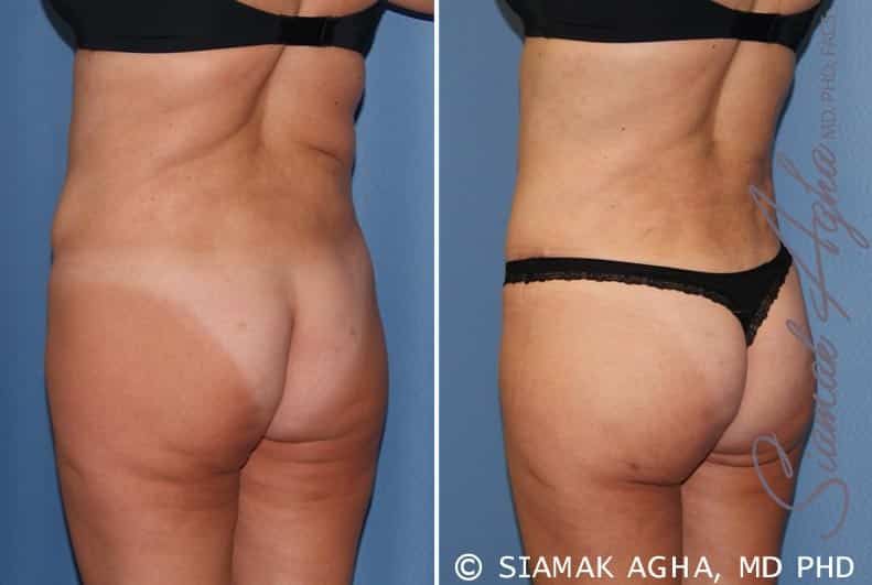 Tummy Tuck Revision Before & After