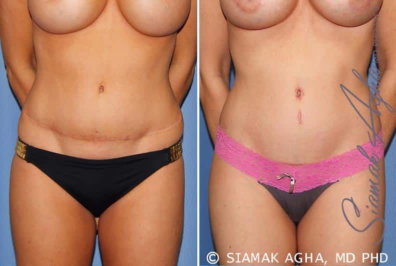 Tummy Tuck Revision Before & After