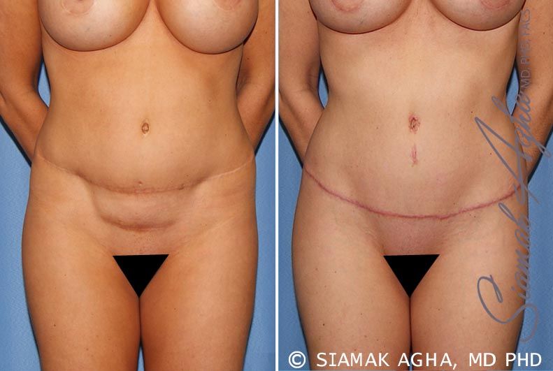 Tummy Tuck Revision Before & After